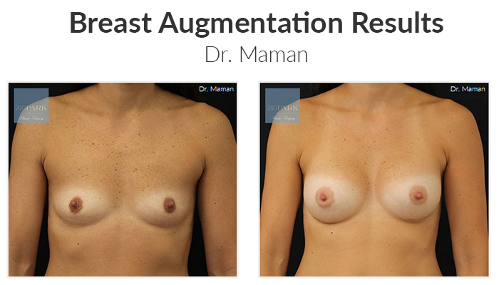 Smaller implants results - Dr. Maman.