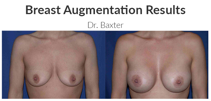 Smaller implants results - Dr. Baxter.