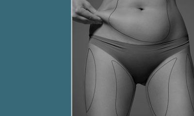 Keys to ensuring successful liposuction.