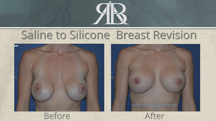 Saline to silicone before and after.