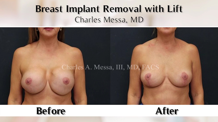 Breast implant removal results.
