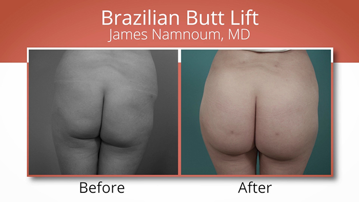 Fat transfer - buttocks.