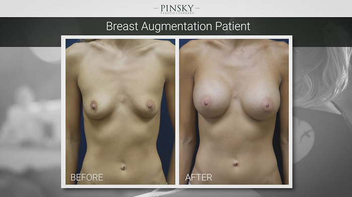 Breast augmentation before and after - Dr. Pinsky.
