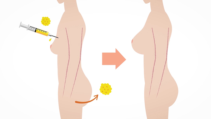 Fat transfer overview.