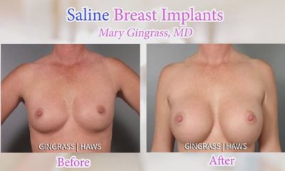 Sasline vs. silicone - saline before and afters.