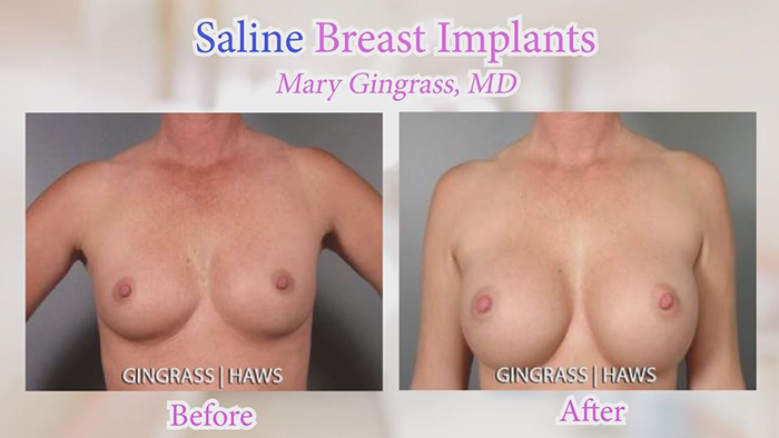 Sasline vs. silicone - saline before and afters.