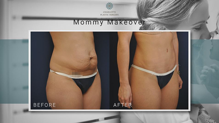 Tummy tuck - mommy makeover.