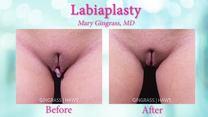 Labiaplasty results - Dr. Gingrass.