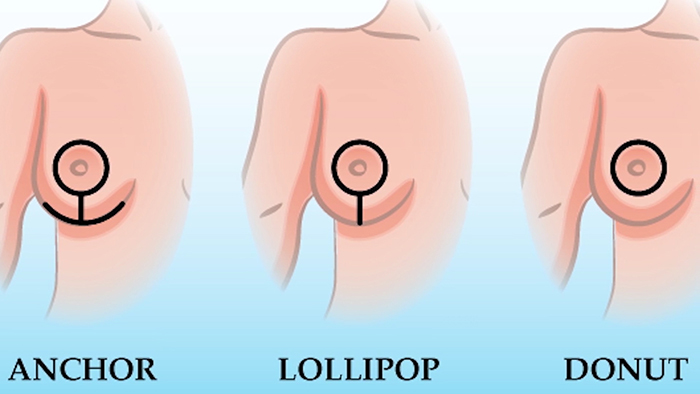 Breast lift scars.