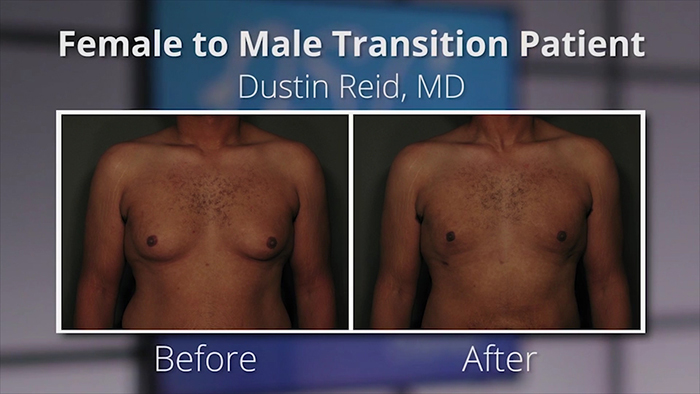 Female-to-male top surgery.