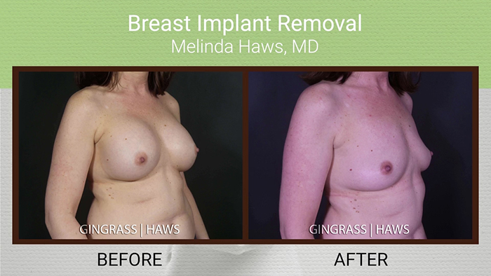 Breast implant removal results - Dr. Haws.
