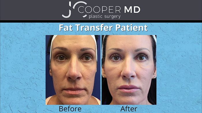 Fat transfer for the mid face.