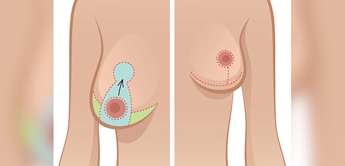 Breast lift diagram.