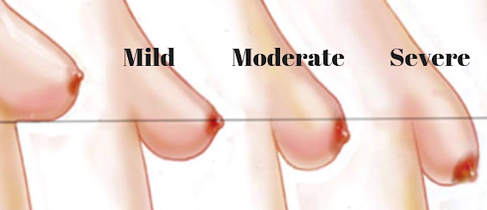 Breast ptosis in breast lift.