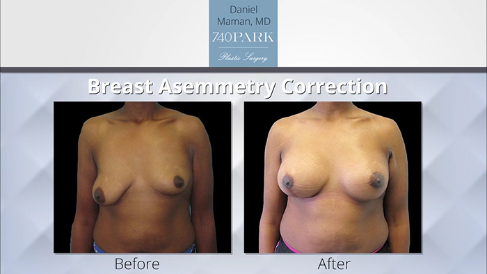 Surgery on uneven breasts.