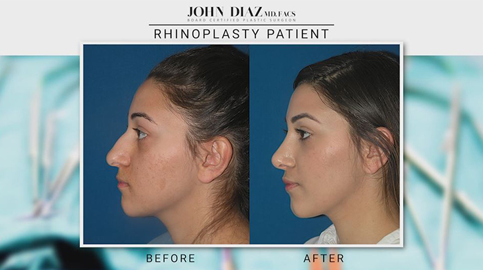 Natural rhinoplasty results - John Diaz, MD.