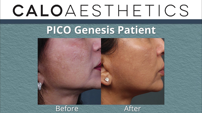 PICO Genesis laser - results.