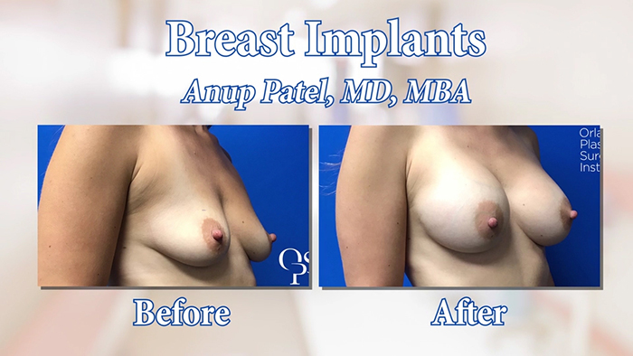 Breast lift results - Dr. Patel.
