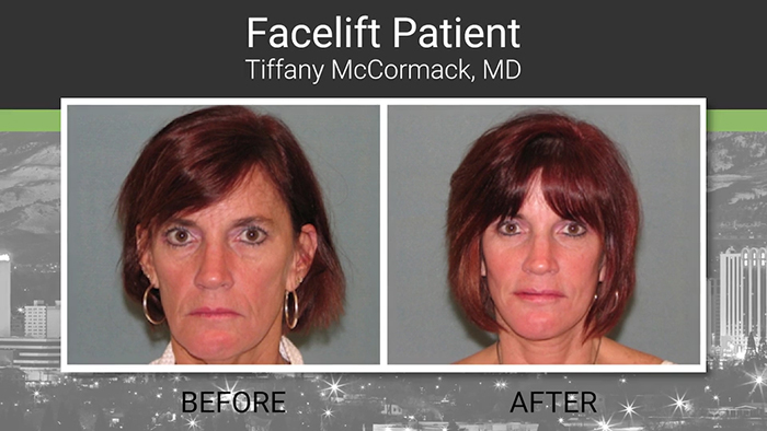 Facelift results - Dr. McCormack.