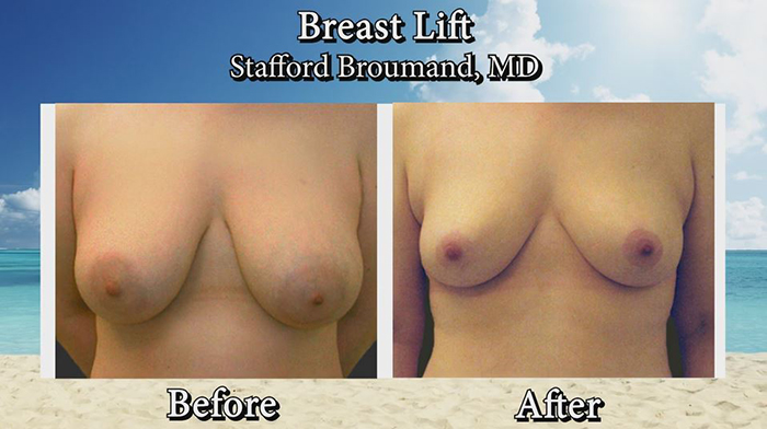 Sagging breast fix - underboob.
