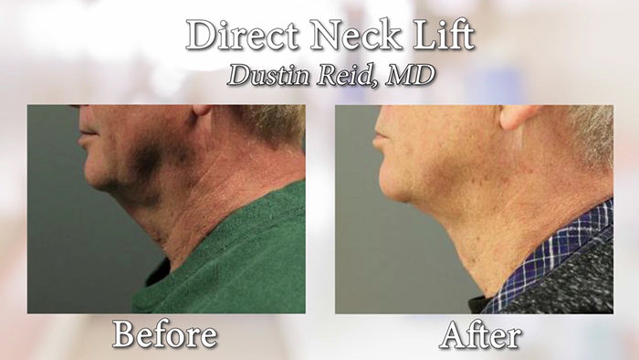 Direct necklift results - before and after.