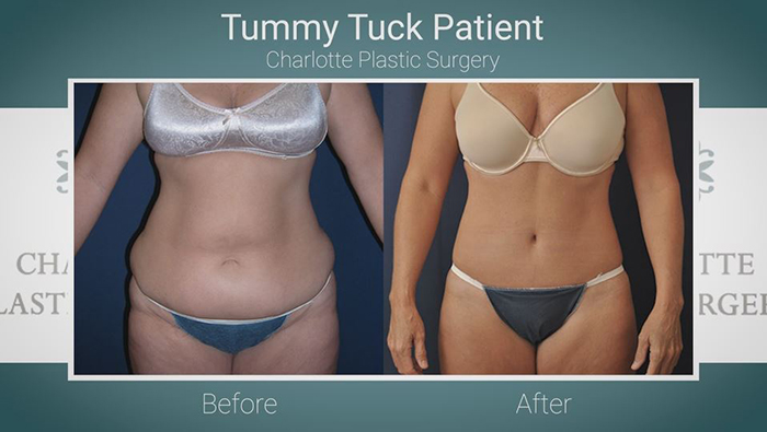 Drainless tummy tuck - Dr. Finical.