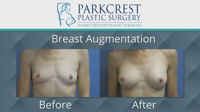Breast implants results - Dr. McGuire.