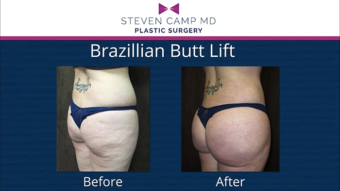 Buttock augmentation before and after - Steven Camp, MD.