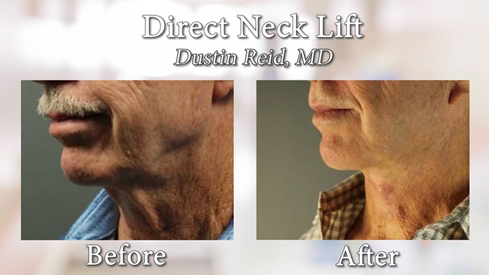 Direct neck lift results.