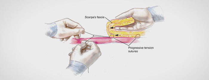 Progressive tension sutures for a drainless tummy tuck.