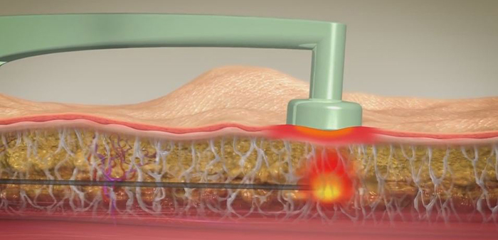 BodyTite - minimally-invasive arm lift.