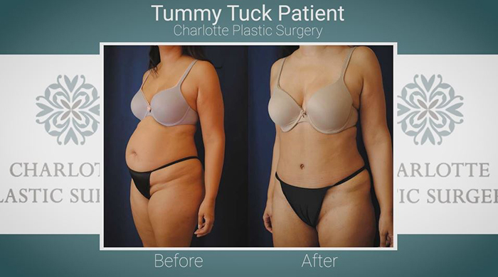 Drainless tummy tuck results.