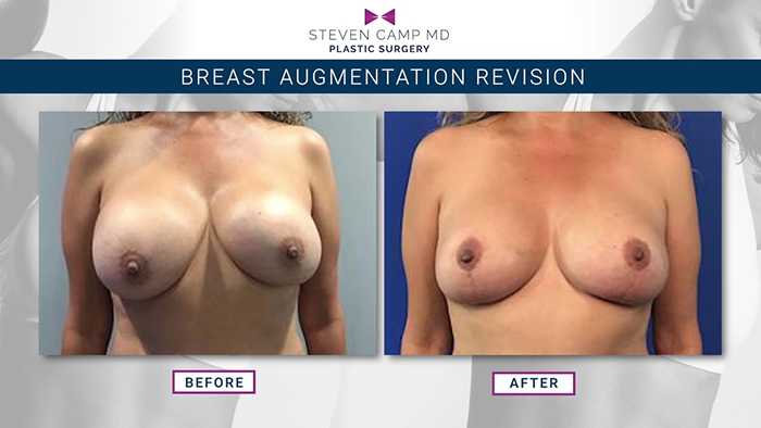 Breast augmentation revision results #2.