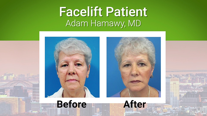 Facelift patient #2 - Hamawy.