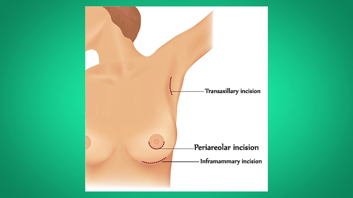 Breast lift scar patterns.