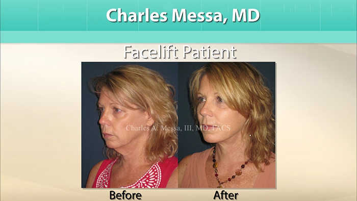 Moderation - Facelift with Dr. Messa.