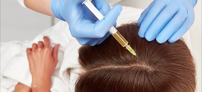 PRP injections for hair loss.