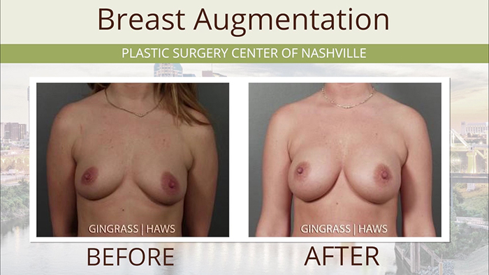 Breast augmentation with new implants - Dr. Haws. 