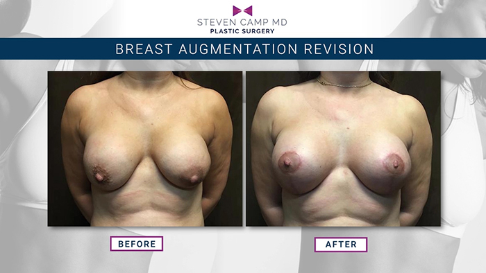 Breast augmentation revision results.