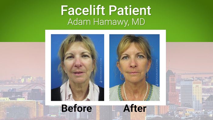 Facelift patient - Dr. Hamawy.