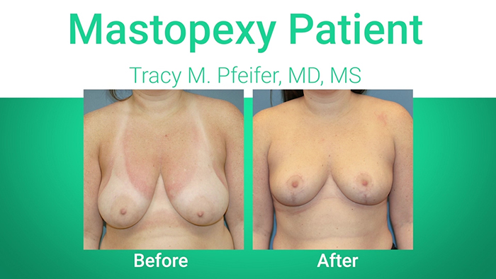 Mastopexy patient - Dr. Pfeifer.