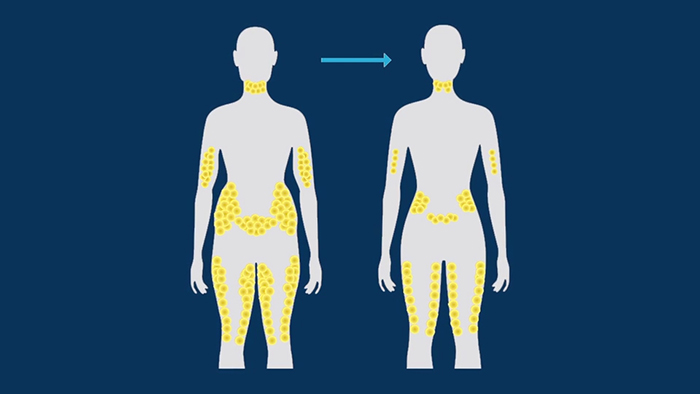 CoolSculpting problem areas.