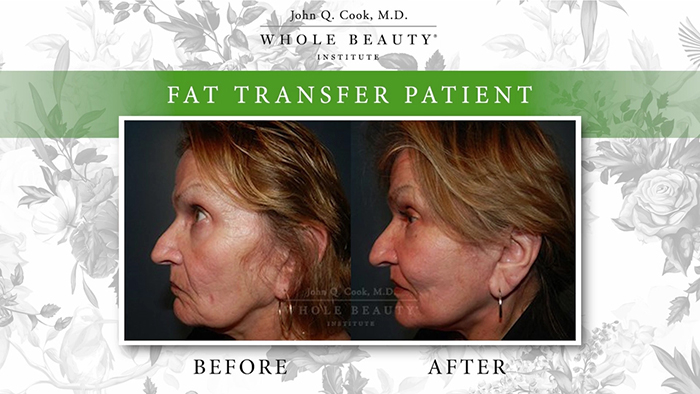 Facial volume loss results - Dr. Cook.