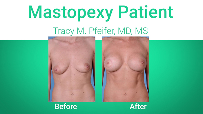 Breast lift patient - Dr. Pfeifer.