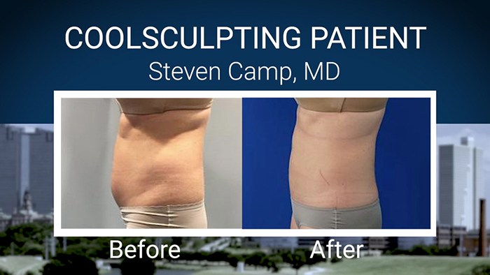 CoolSculpting patient - Dr. Camp.