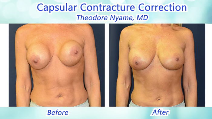 Breast revision results - Dr. Nyame.