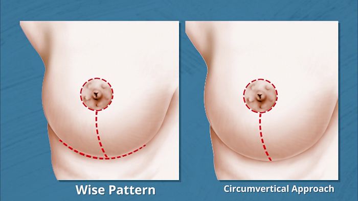 Breast lift with mesh scar placement.