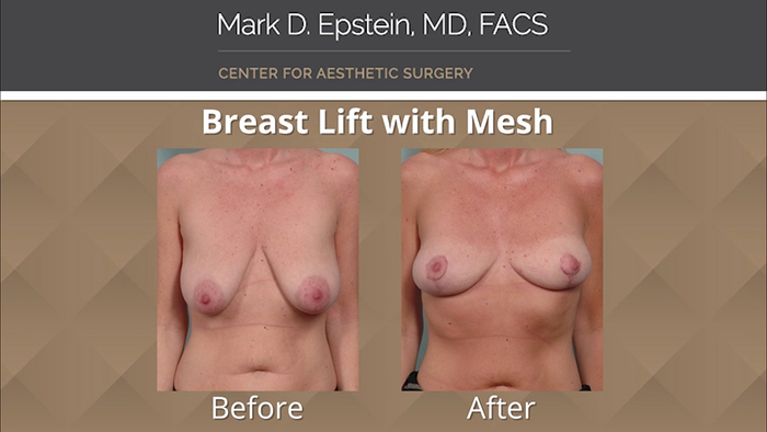 Breast lift with mesh results.