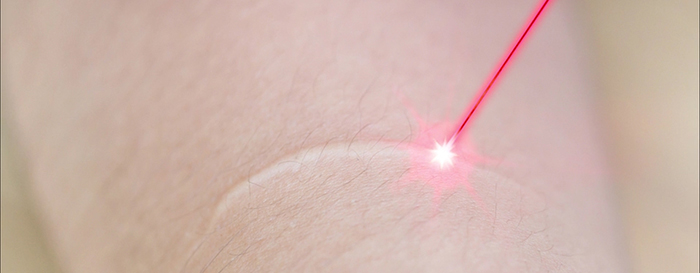 Laser treatments for scars.