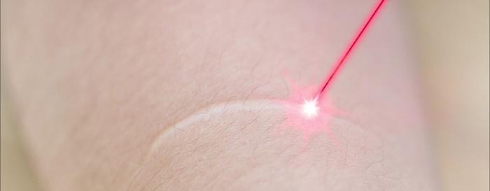 Laser treatments for scars.